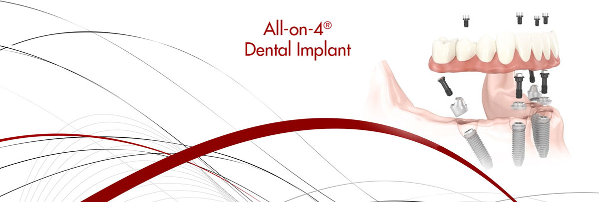 Delray Beach All-on-4 Dental Implants