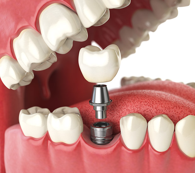 Delray Beach Will I Need a Bone Graft for Dental Implants