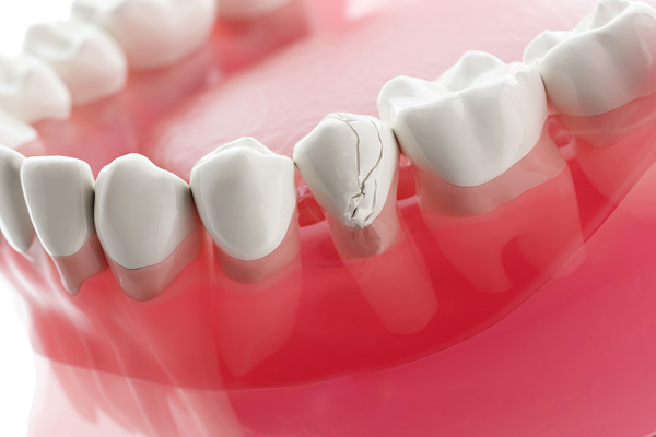 When A Broken Tooth Will Require A Root Canal