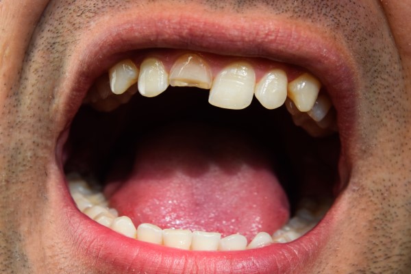 How A Dentist Can Treat A Broken Tooth