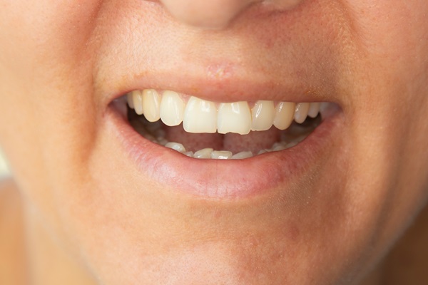 Chipped Tooth Repair Options: Bonding, Veneers, And More
