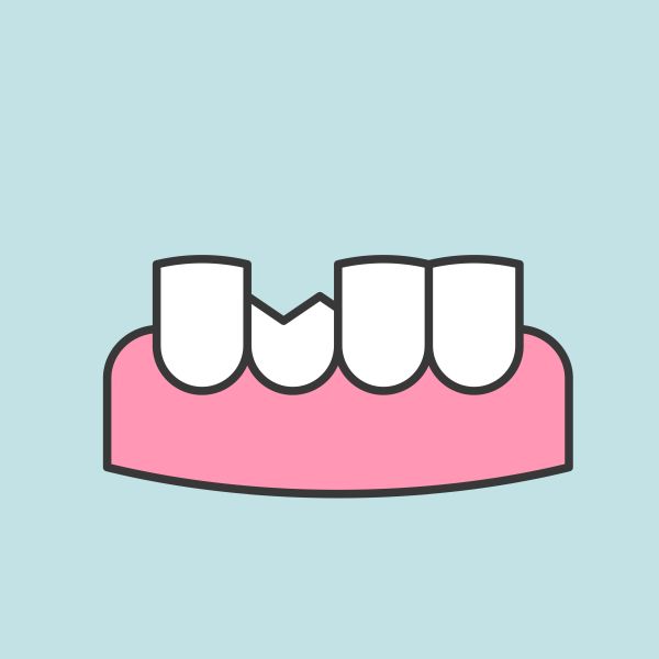 chipped tooth chipped tooth