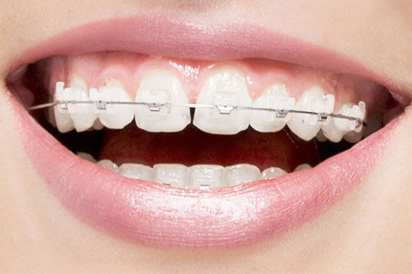 Are Clear Braces A Popular Option For Teeth Straightening?