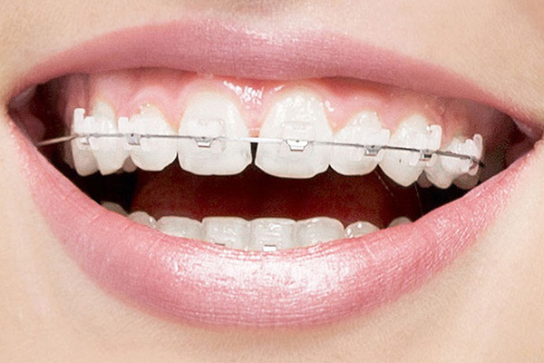 Invisible braces, Clear dental braces, Teeth braces