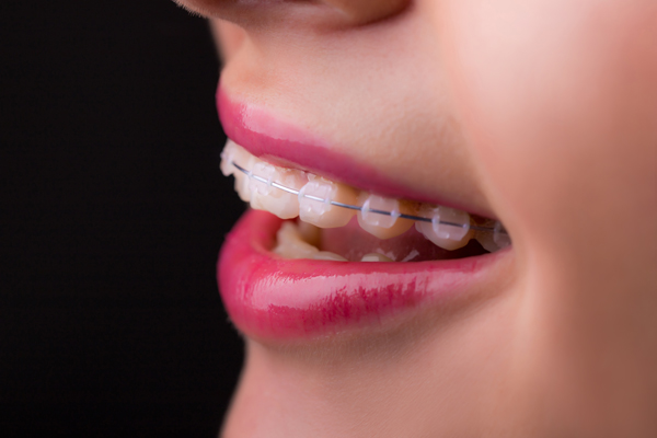 Clear Braces, Aligners, And Other Discreet Orthodontic Treatments