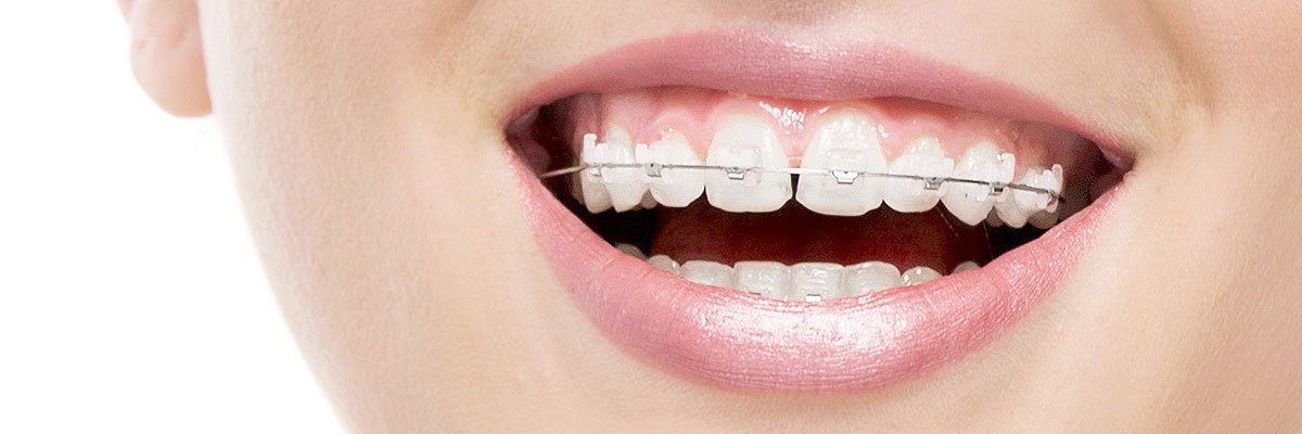 Delray Beach Invisible Orthodontics