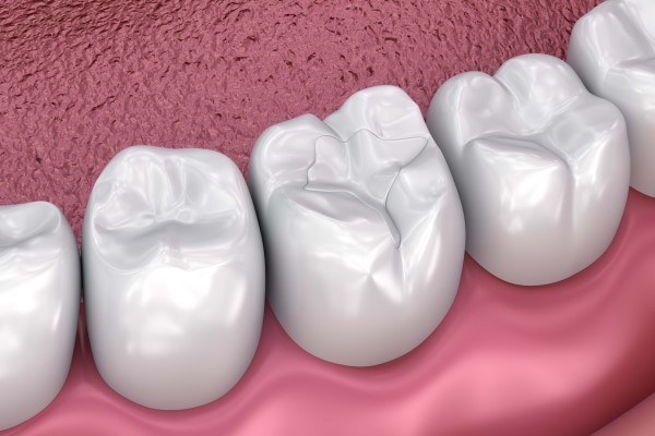 When Should You Get Dental Fillings?