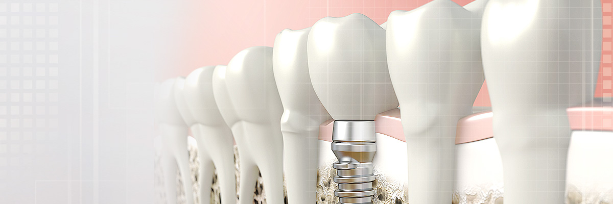 Delray Beach Tooth Colored Fillings