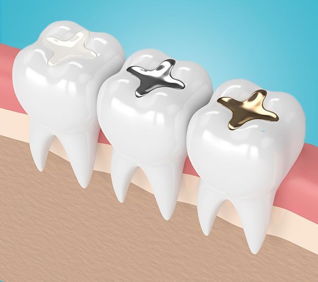 Delray Beach Composite Fillings