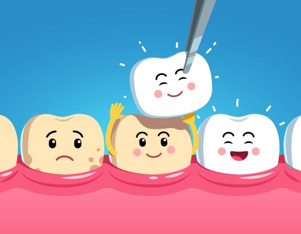 What To Expect When Having Dental Veneers Placed