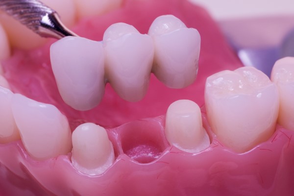 What Materials Are Used In A Dental Bridge?