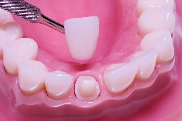 When A Dental Crown Is Needed For A Cavity