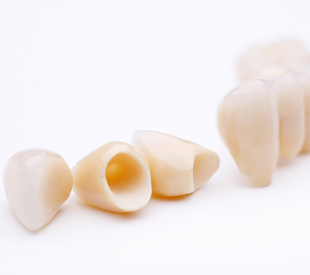 Delray Beach Dental Crowns and Dental Bridges