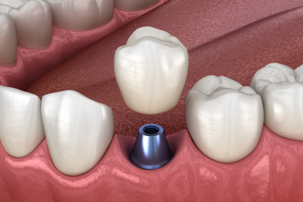 How Long Does It Take For The Gums To Heal After An Implant Restoration?