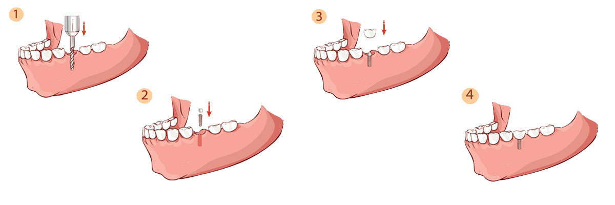 Delray Beach Dental Implant Restoration