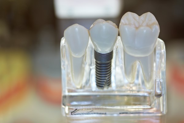 Dental Implants Delray Beach, FL