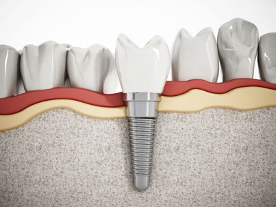 Are You Looking For Mini Dental Implants Near Delray Beach?