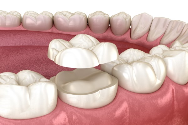 Dental Onlay Advantages: Conservative Restorations That Preserve Natural Structure