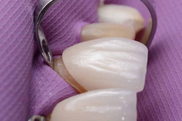 Cosmetic Dentistry: Improving Smiles With Porcelain Veneers