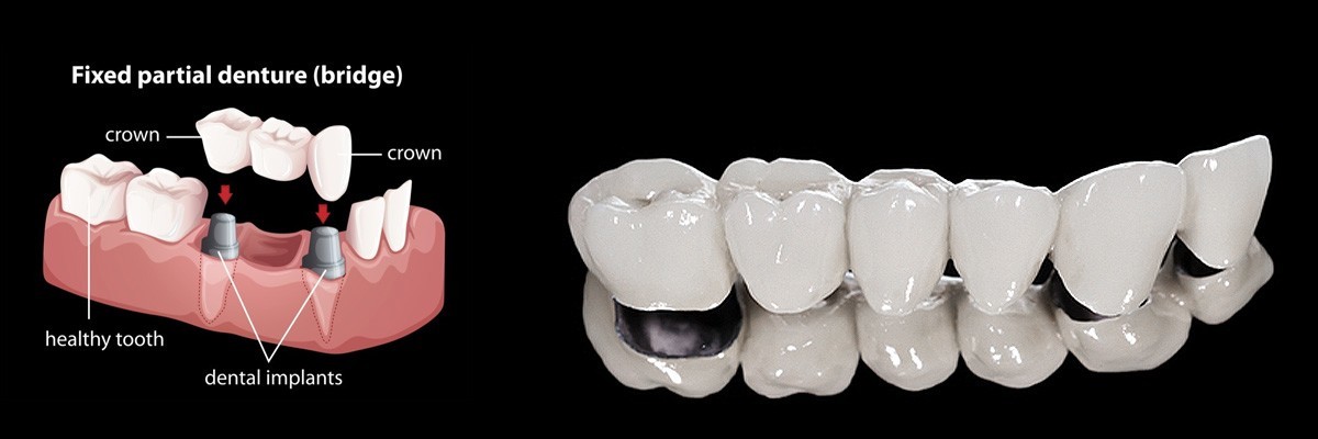 Delray Beach Dentures