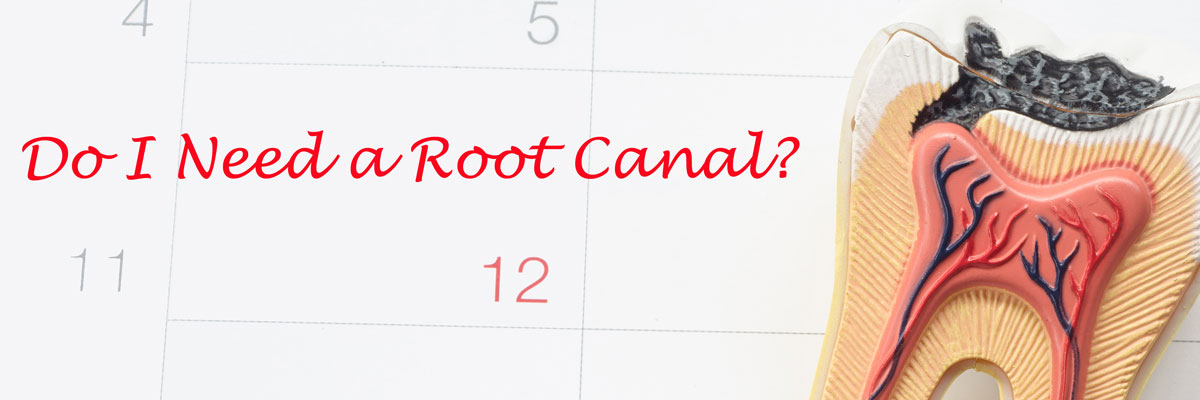 Delray Beach Do I Need a Root Canal