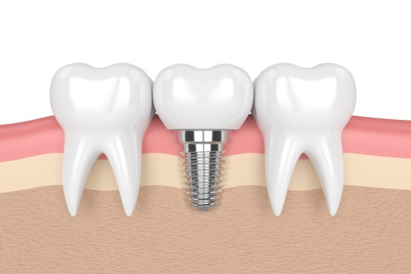 Implant Dentist Delray Beach, FL
