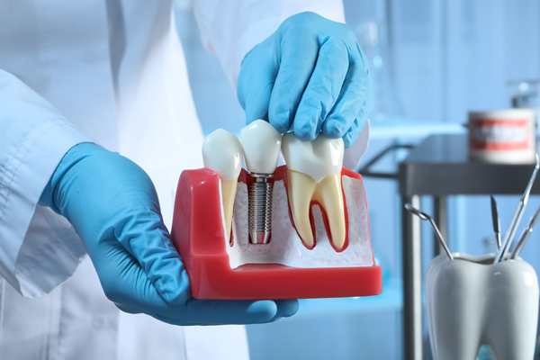 The Different Types Of Dental Implant Restorations