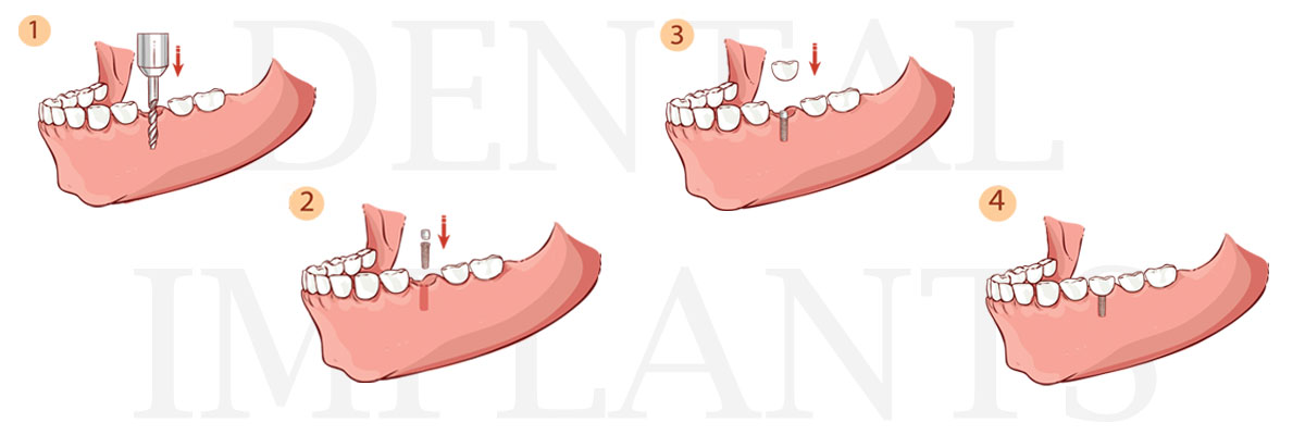 Delray Beach The Difference Between Dental Implants and Mini Dental Implants