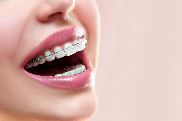Choosing Invisalign Over Traditional Braces For Teens