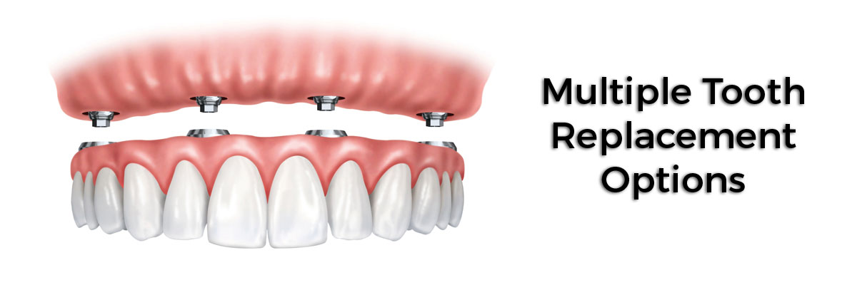Delray Beach Multiple Teeth Replacement Options