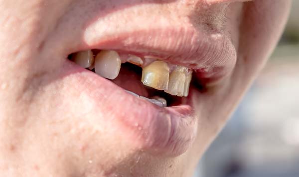 Partial Dentures Vs  Dental Implants: Which Is Best For You?