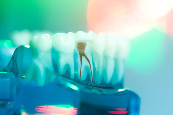 What Can Happen If You Avoid A Root Canal Treatment