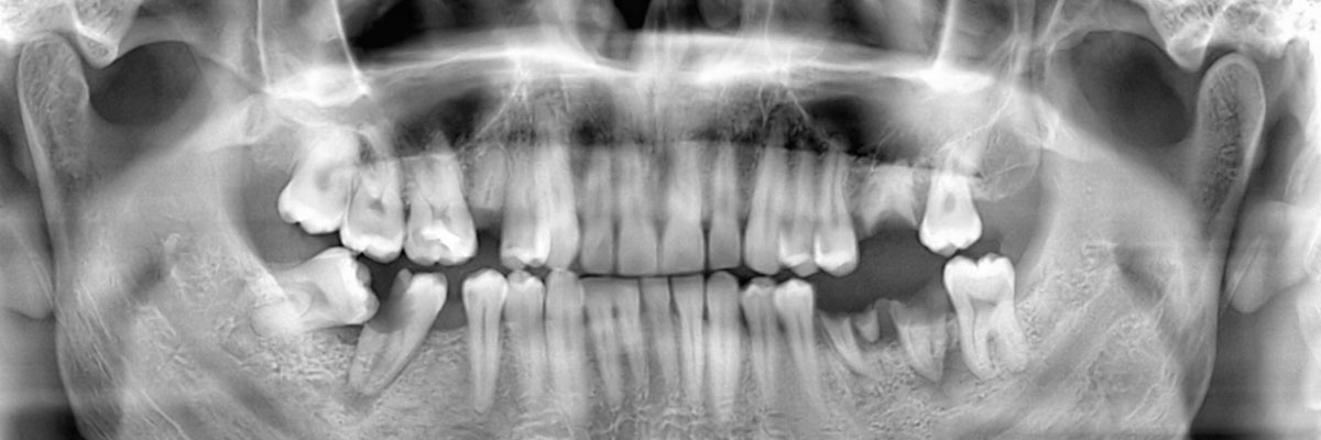 Delray Beach Wisdom Teeth Extraction