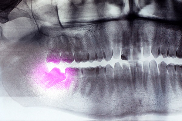 Wisdom Teeth Extraction: What To Expect Before, During, And After
